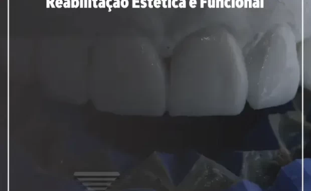 Enceramento Diagnóstico e Mock-Up na Reabilitação Estética e Funcional